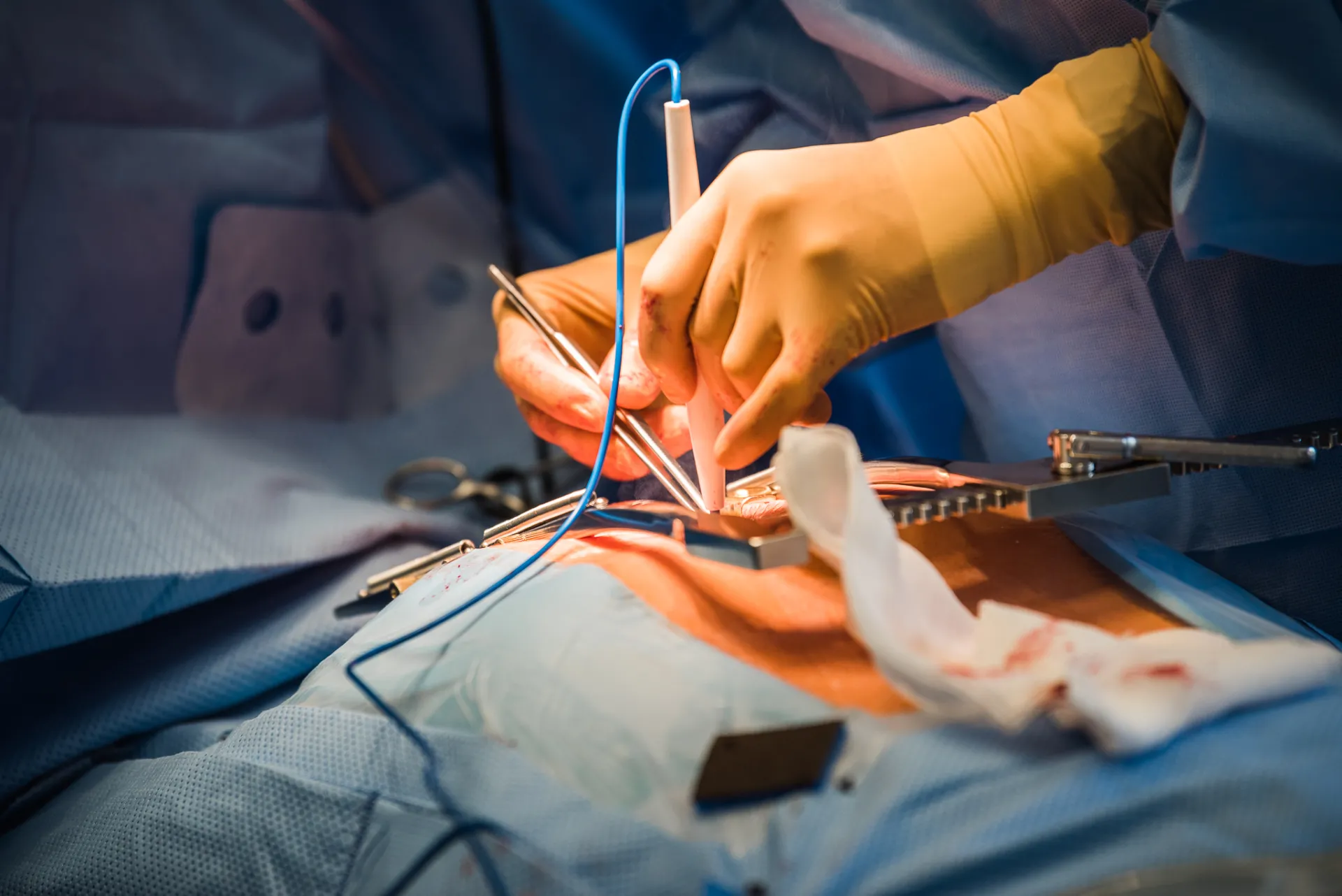 Tuvplāna medicīniskā ķirurģiskā aina rāda, kā cimdiem apvilktas rokas izmanto elektroķirurģisko instrumentu un pinceti atklātā operācijas vietā, kurā ir novietots retraktors. Operāciju zāle ir apgaismota ar siltu, koncentrētu gaismu, kas šajā dokumentālā stilā veidotajā medicīniskajā fotogrāfijā rada saspringtu, klīnisku noskaņu.